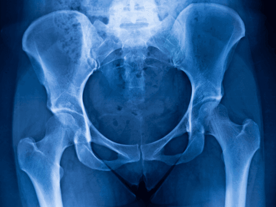 Pelvic Acetabular Surgery in Solapur