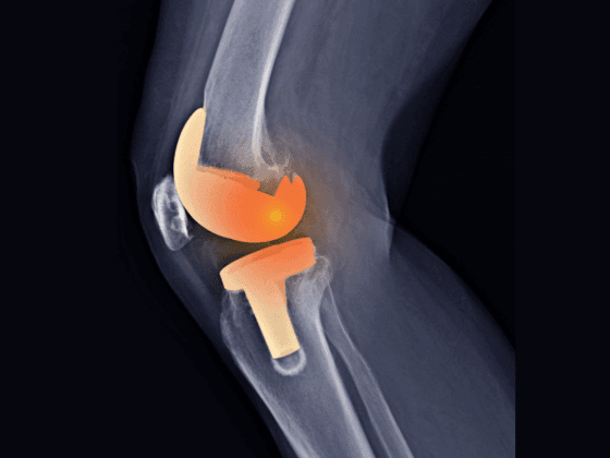 Knee Replacement Treatment in Solapur