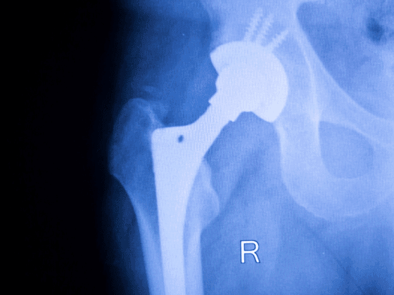 Hip Replacement Surgery in Solapur