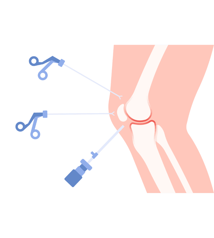 Knee Arthroscopy in Solapur