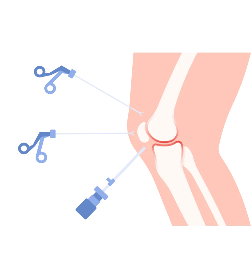 Knee Arthroscopy in Solapur