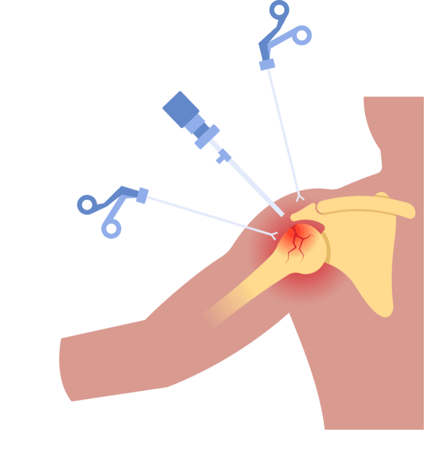 Shoulder & Knee Arthroscopy in Solapur