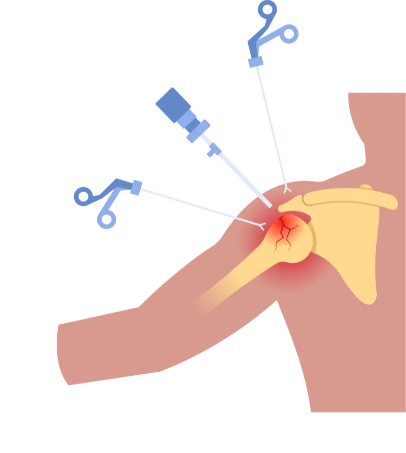 Shoulder & Knee Arthroscopy in Solapur