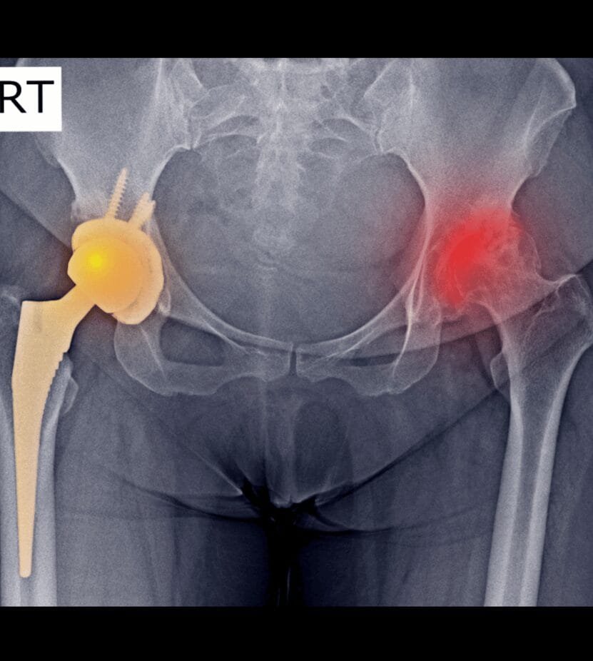 hip replacement in Solapur