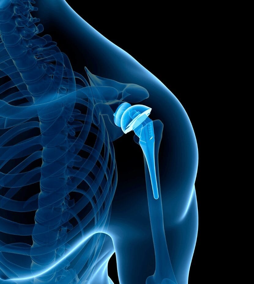 shoulder replacement in Solapur