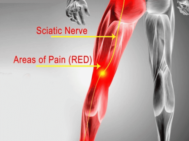 sciatica doctor in solapur
