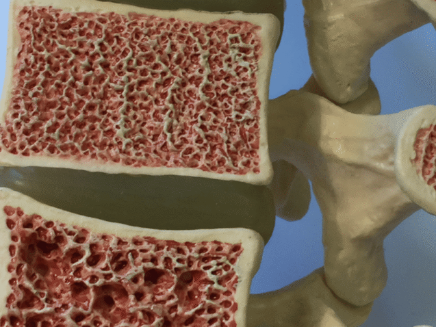 Weak Bones Treatment in Solapur