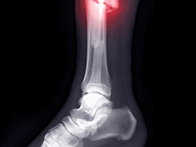 Fracture Risk Assessment Solapur